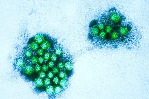 North Texas Middle School Closes Due to Norovirus Outbreak