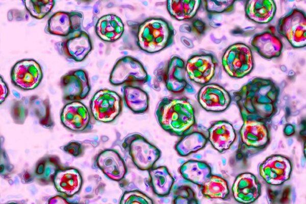 Rockwall County Reports Five Confirmed Measles Cases: What You Need to Know