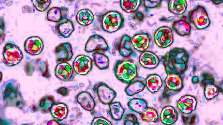 Rockwall County Reports Five Confirmed Measles Cases: What You Need to Know